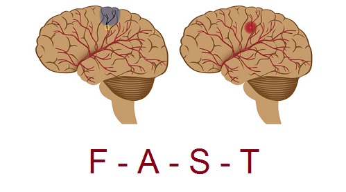 รู้ทันอาการสมองขาดเลือดด้วย FAST
